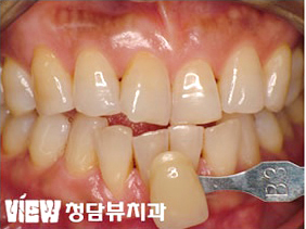 치아미백